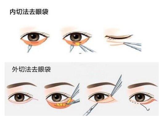 眼袋要這樣子切才能做到徹底
