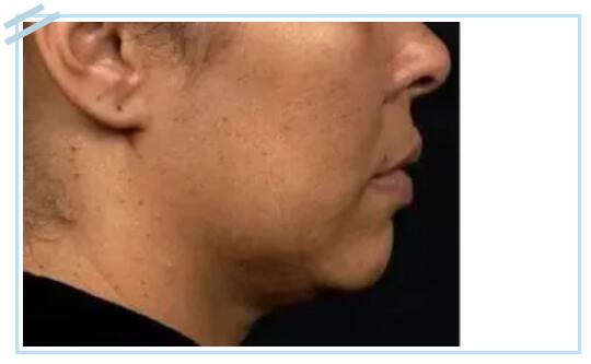 網(wǎng)紅抗衰項目熱瑪吉