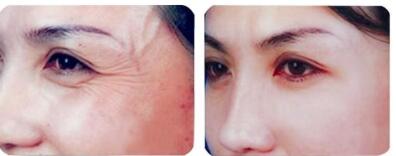 魚尾紋的四個等級