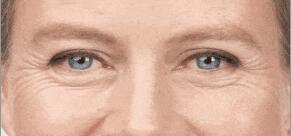 魚尾紋的四個等級