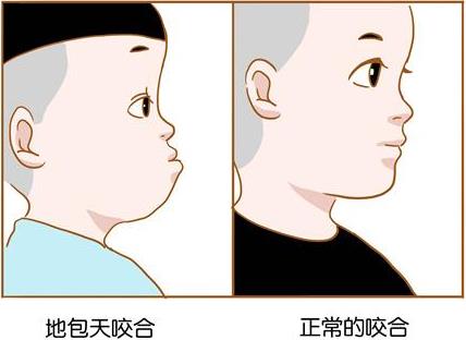 兜齒矯正的較佳年齡是多少歲?別讓兜齒影響孩子的一生!