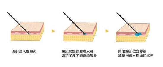 姣蘭玻尿酸的特性大介紹