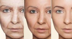 自體脂肪可以填充法令紋嗎?術(shù)后有什么注意事項嗎