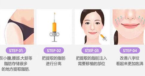 自體脂肪可以填充法令紋嗎?術(shù)后有什么注意事項(xiàng)嗎