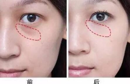 自體脂肪填充淚溝有需要特別注意的嗎?注意事項大全公開