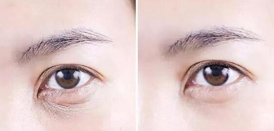 魚尾紋怎么去除?調(diào)節(jié)方法有哪些?