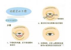 激光和內(nèi)切祛眼袋哪個(gè)更持久?