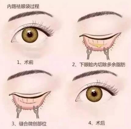 激光和內(nèi)切祛眼袋哪個更持久?