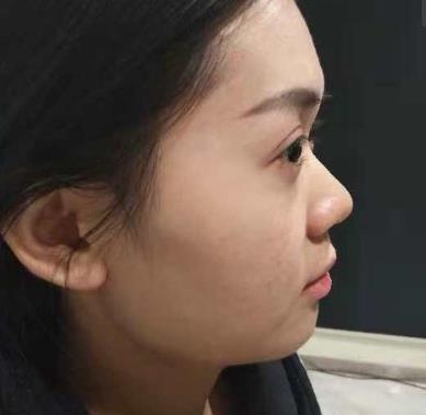成都奕后孟祥宏醫(yī)生做隆鼻修復(fù)咋樣?僅三個(gè)月就宛若天生