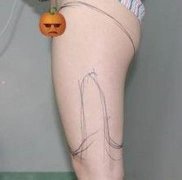 南京美貝爾案例：小姐姐抽脂瘦腿果公開(kāi)放松