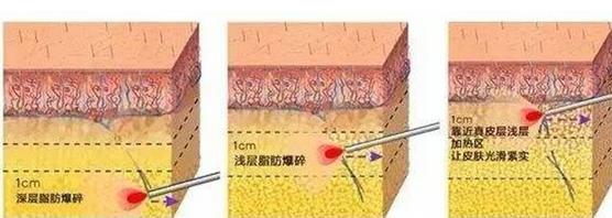 面部光纖溶脂幾年后的危害是什么?提前預(yù)知準沒錯