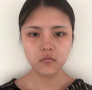 我在福州親身體驗(yàn)的埋線提升去法令紋果分享