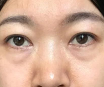 青醫(yī)附院匡瑞霞技術(shù)怎么樣？看祛眼袋真人前后對比圖