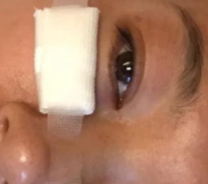 青醫(yī)附院匡瑞霞技術(shù)怎么樣？看祛眼袋真人前后對比圖