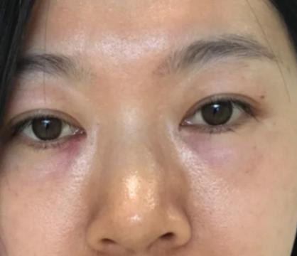 青醫(yī)附院匡瑞霞技術(shù)怎么樣？看祛眼袋真人前后對比圖