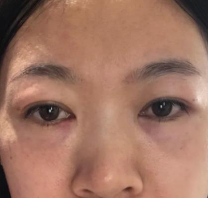 青醫(yī)附院匡瑞霞技術(shù)怎么樣？看祛眼袋真人前后對比圖