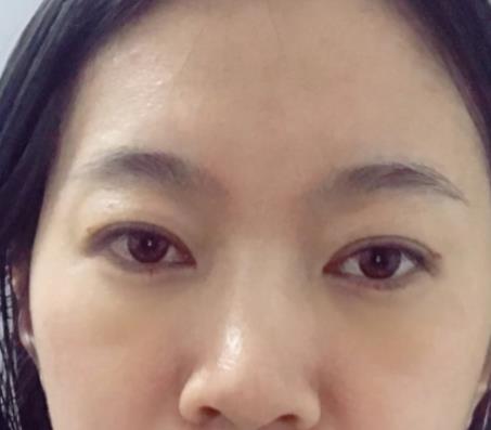 青醫(yī)附院匡瑞霞技術(shù)怎么樣？看祛眼袋真人前后對比圖