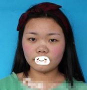 武漢亞太醫(yī)院整鼻子果怎么樣？恢復記錄&果圖