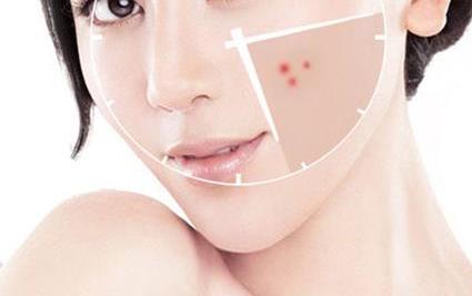 祛痘紅藍(lán)光祛痘果怎么樣？調(diào)節(jié)后會復(fù)發(fā)嗎？