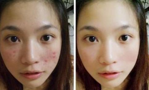 祛痘紅藍(lán)光祛痘果怎么樣？調(diào)節(jié)后會復(fù)發(fā)嗎？