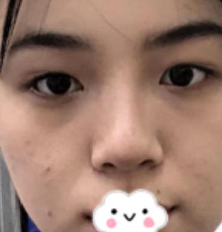 北京趙延勇醫(yī)生口碑好嗎？雙眼皮案例果公布