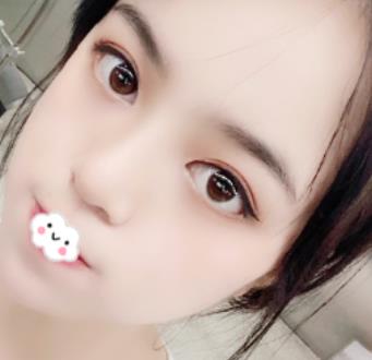 北京趙延勇醫(yī)生口碑好嗎？雙眼皮案例果公布