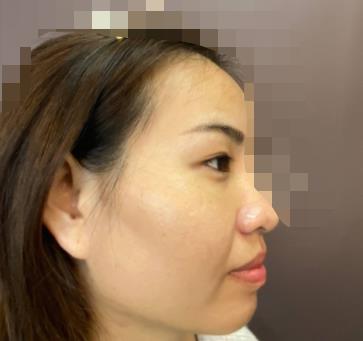 北京楊明勇技術(shù)好嗎？真人親身經(jīng)歷記錄&果展示