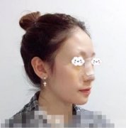 北京協(xié)和醫(yī)院整形科隆鼻果好嗎/實(shí)拍圖真人/鼻整形價(jià)格表