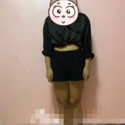 在上海第九人民醫(yī)院整形科做了大腿吸脂，輕松擺脫大象腿