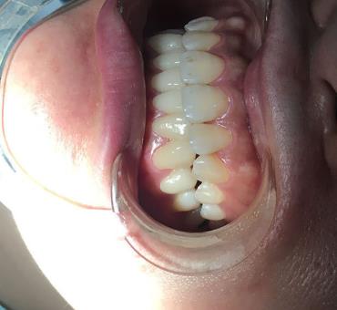 四川省人民醫(yī)院口腔科李崢醫(yī)生咋樣?牙齒矯正費用多少?