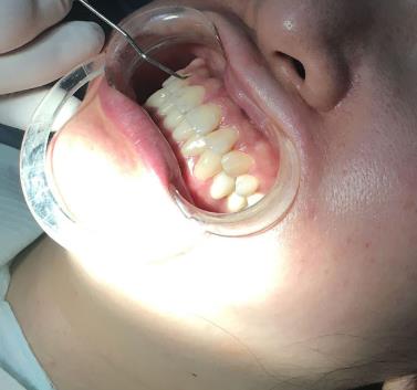 四川省人民醫(yī)院口腔科李崢醫(yī)生咋樣?牙齒矯正費用多少?