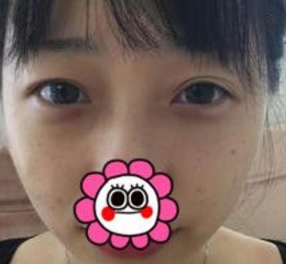 【冷向鋒案例】青醫(yī)附院雙眼皮術(shù)后恢復(fù)記錄公開，速覽