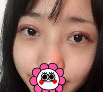 【冷向鋒案例】青醫(yī)附院雙眼皮術(shù)后恢復(fù)記錄公開，速覽