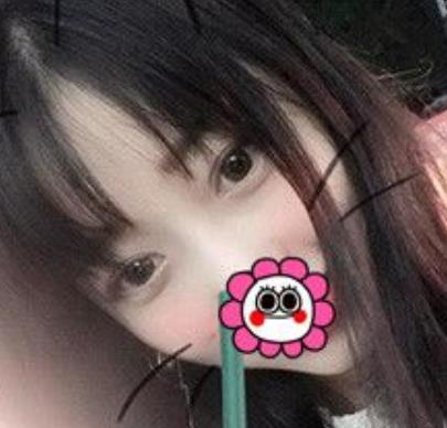 【冷向鋒案例】青醫(yī)附院雙眼皮術(shù)后恢復(fù)記錄公開，速覽