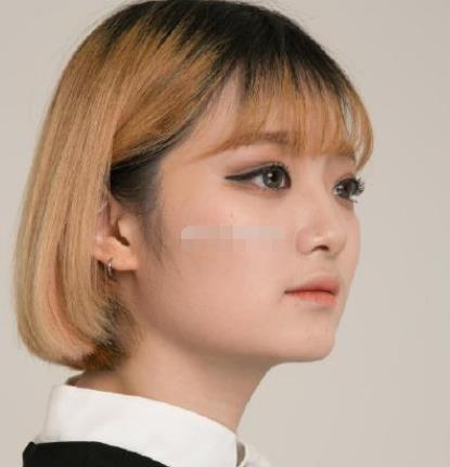 上海九院韋敏磨骨怎么樣?術(shù)后日記經(jīng)驗(yàn)分享