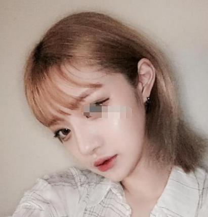 上海九院韋敏磨骨怎么樣?術(shù)后日記經(jīng)驗(yàn)分享