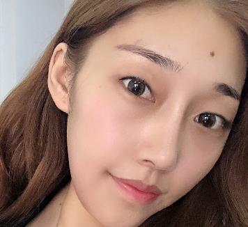 廣州美萊陳貴宗割雙眼皮好嗎?醫(yī)生簡介+前后對照圖片