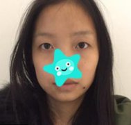 揭秘：常州和平醫(yī)院整形美容科隆鼻果，真人做鼻子50天恢復經(jīng)驗