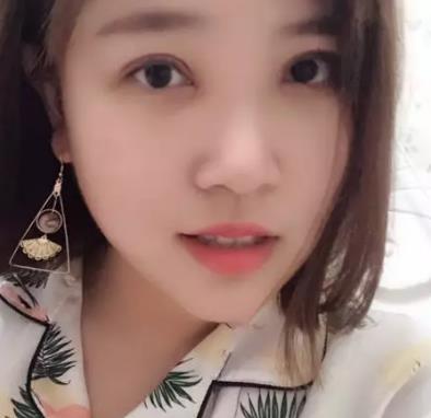 【朱曉峰】雙眼皮做得如何？有術后四個月案例鑒定果