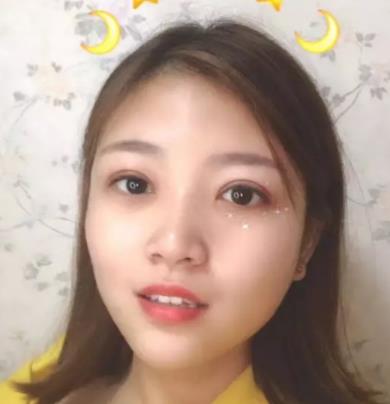 【朱曉峰】雙眼皮做得如何？有術后四個月案例鑒定果