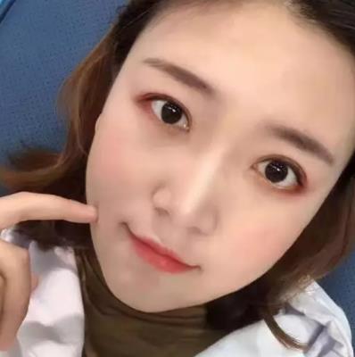 【朱曉峰】雙眼皮做得如何？有術后四個月案例鑒定果