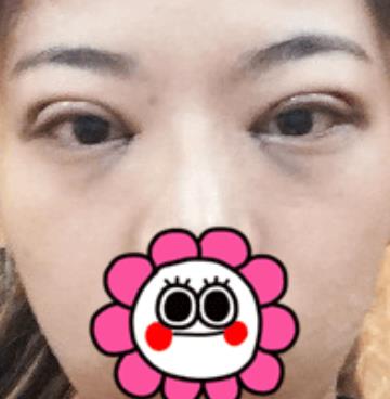 北京八大處滕利做雙眼皮怎么樣？給你們真實日記反饋