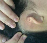 【蔣海越案例】北京八大處耳再造術(shù)后恢復(fù)記錄&果圖