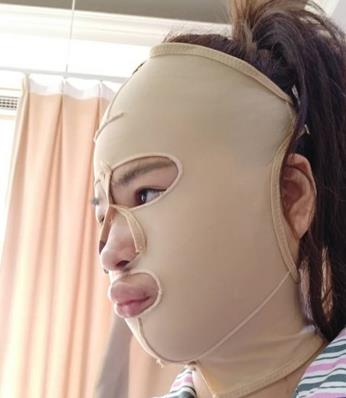 【張笑天】磨骨怎么樣？醫(yī)生介紹及真人案例分享