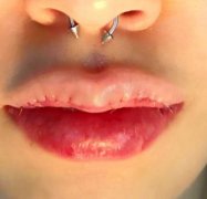 八大處宋濤案例：小姐姐厚唇改薄果圖&記錄