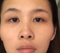 成都玉之光整形醫(yī)院豐太陽穴真人術后恢復實述