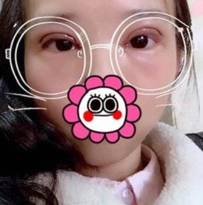 沈陽(yáng)杏林張瑩瑩雙眼皮案例？看醫(yī)生簡(jiǎn)介和技術(shù)如何