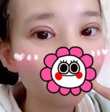 沈陽(yáng)杏林張瑩瑩雙眼皮案例？看醫(yī)生簡(jiǎn)介和技術(shù)如何