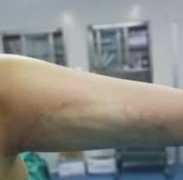 南京鼓樓醫(yī)院美容科價(jià)目表（價(jià)格），手臂吸脂案例圖鑒！