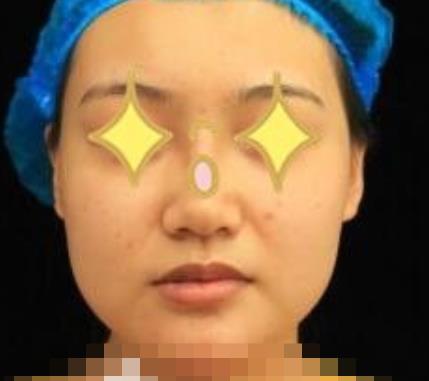 上海伊美爾港華醫(yī)院磨骨真人案例果圖流出：對比挺明X